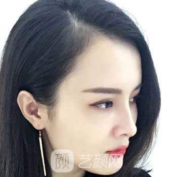 北京美莱王旭东实例，做鼻子技术水平怎么样？看看修复图片