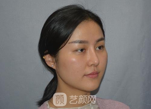 南京康美医院陈小剑做双眼皮怎么样？2022招牌实例出炉