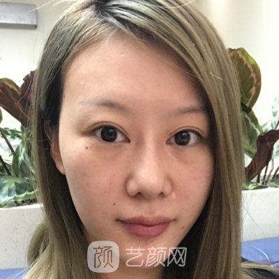 义乌张小红医疗美容医院正规吗？全新面部提升实例展示