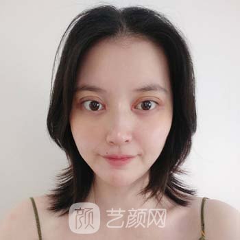 上海柴云做双眼皮修复怎么样？医生简介+双眼皮修复实例