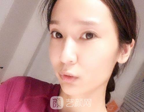 南京连天美整形医院玻尿酸面部填充实例出炉｜附体验对比图