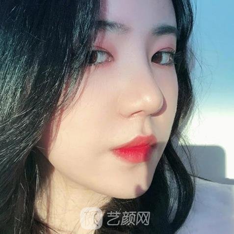 郑州上上善美整形医院做鼻子怎么样？2022招牌实例出炉