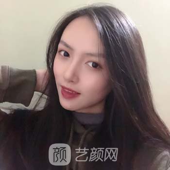 房志强隆鼻实例，出血量小，修复快，鼻子美美哒！