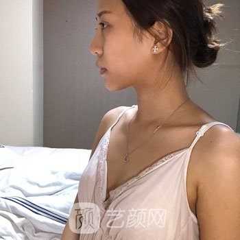 杭州美莱隆胸失败修复实例多吗？真人口述修复全过程一览