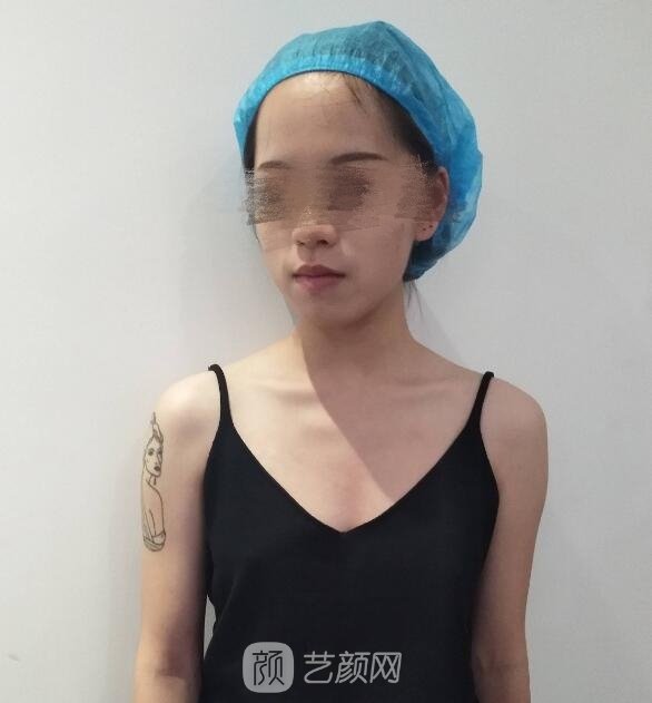 付腾鹏医生隆胸实例，术后三个月真实修复情况记录