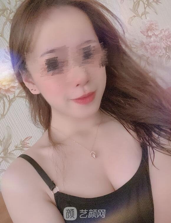 付腾鹏医生隆胸实例，术后三个月真实修复情况记录