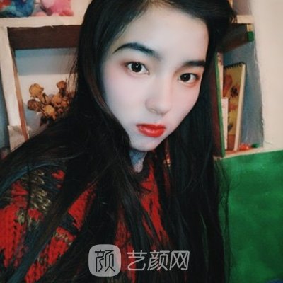 无锡尚美整形医院隆鼻实例发布|90天体验细节图一览