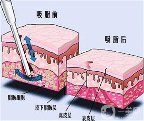 抽脂对身体会不会有影响呢?