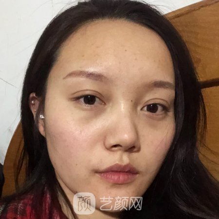 沈阳杏林王贵雄做眼袋怎么样?医生招牌实例公布