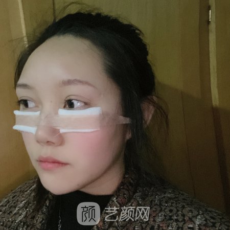 沈阳杏林王贵雄做眼袋怎么样?医生招牌实例公布