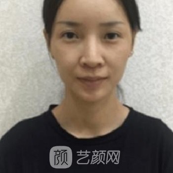 军美章小平隆鼻实例对比图，容貌精致了好多，超级美丽