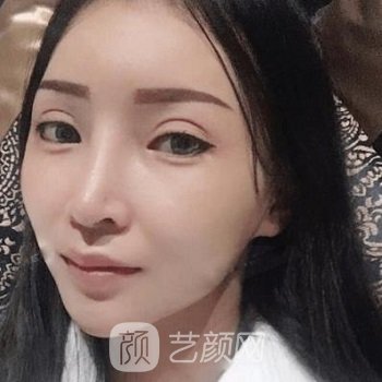 军美章小平隆鼻实例对比图，容貌精致了好多，超级美丽