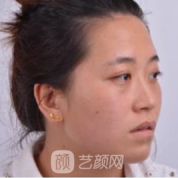 邵逸夫李华隆鼻实例，亲身经历分享鼻部整形手术别错过