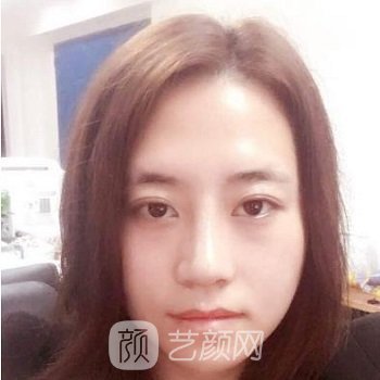 邵逸夫李华隆鼻实例，亲身经历分享鼻部整形手术别错过