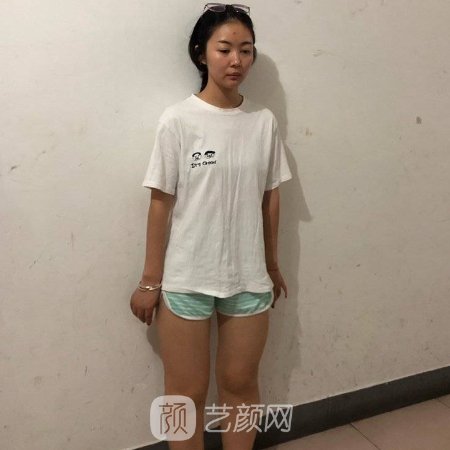 上海美莱全身抽脂大概要多少钱?官网价格表及实例分享