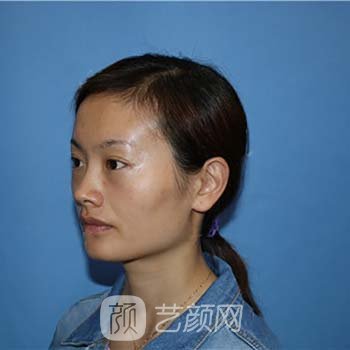 脂肪填充全脸当天照片，看着丑，修复两个月就漂亮了许多