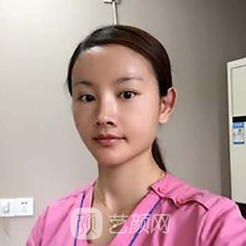 脂肪填充全脸当天照片，看着丑，修复两个月就漂亮了许多