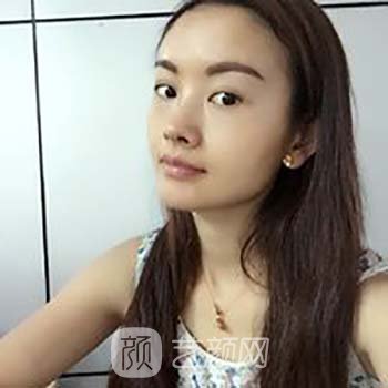 脂肪填充全脸当天照片，看着丑，修复两个月就漂亮了许多