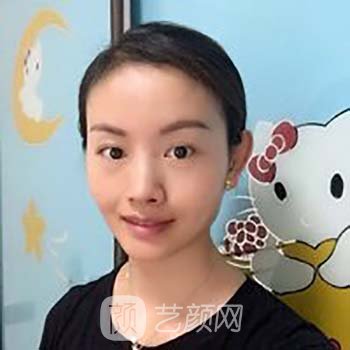 脂肪填充全脸当天照片，看着丑，修复两个月就漂亮了许多