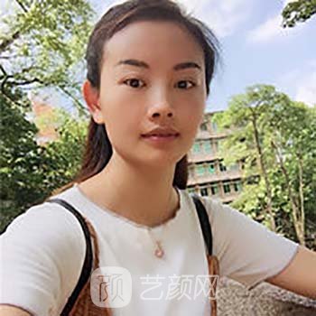 脂肪填充全脸当天照片，看着丑，修复两个月就漂亮了许多
