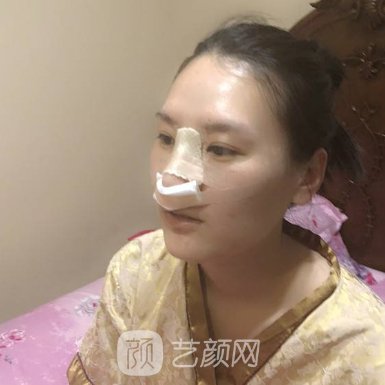 深圳名丽彭静医生做肋骨鼻好吗?2022招牌实例分享