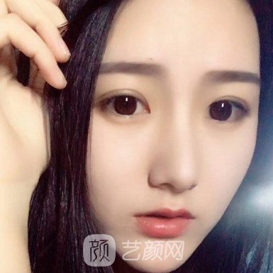 深圳名丽彭静医生做肋骨鼻好吗?2022招牌实例分享