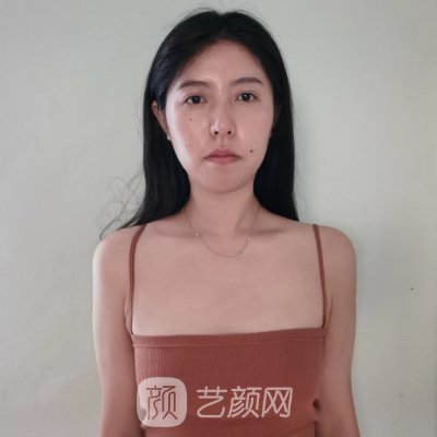 绍兴维美整形医院自体脂肪隆胸实例公开｜附成果图