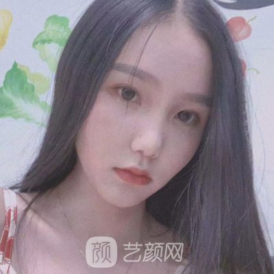 北京艺美整形医院吸脂瘦脸实例公开|成果自然美观