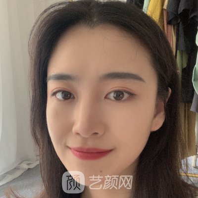 深圳美莱双眼皮技术怎么样?2022招牌实例公布
