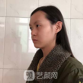 李战强隆鼻失败修复实例，失而复得的美丽鼻形，棒棒哒