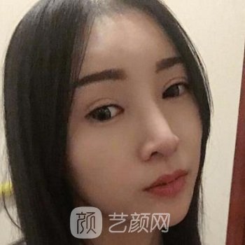 西南医院陈亮隆鼻实例，给我带来丑小鸭变天鹅一样的蜕变