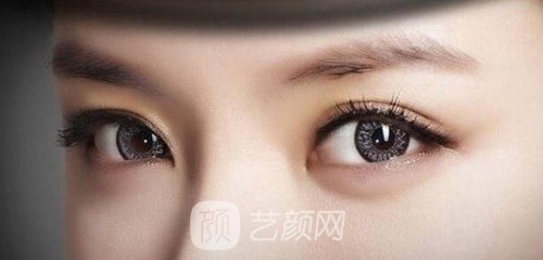 华西李正勇双眼皮做得好不？个人经历分享：美丽变化展示