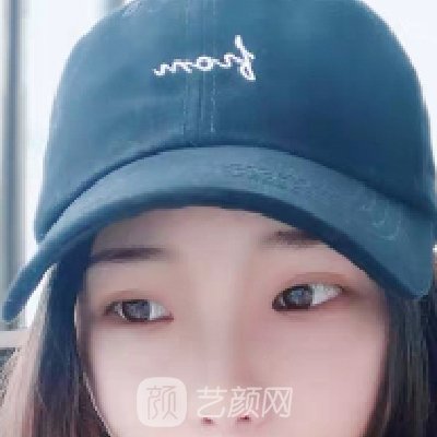 青医附院美容科王彦进割双眼皮怎么样?2022招牌实例展示