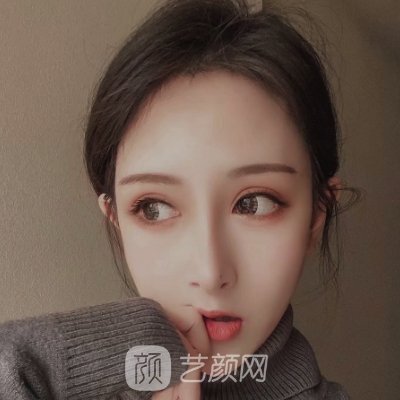辽宁协和整形医院靠谱吗?医院招牌隆鼻实例分享