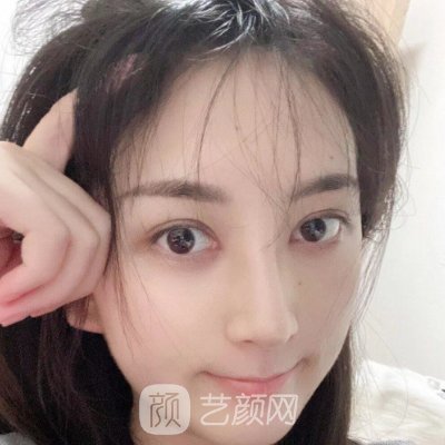 金华中心医院童芸隆鼻好不好?整形成果自然无痕