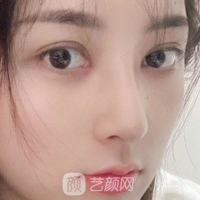 金华中心医院童芸隆鼻好不好?整形成果自然无痕