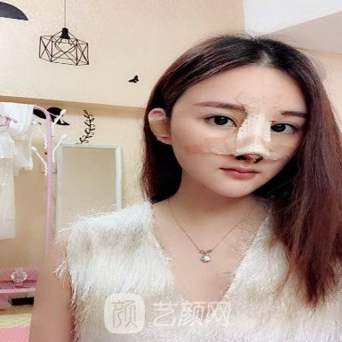 重庆美莱韦小勇隆鼻技术怎么样?2022体验实例展示