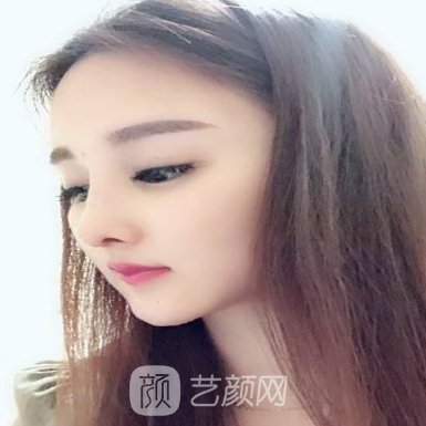 重庆美莱韦小勇隆鼻技术怎么样?2022体验实例展示