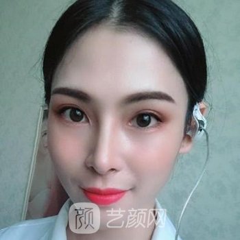 罗延平隆鼻实例，术后两个月变成小仙女，超美腻