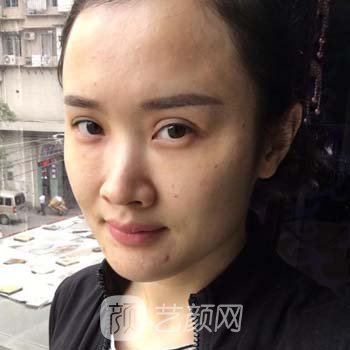 赵广文隆鼻失败修复实例，术后对于鼻子的整体形态感到满意