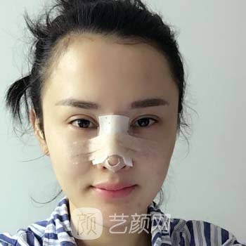 赵广文隆鼻失败修复实例，术后对于鼻子的整体形态感到满意