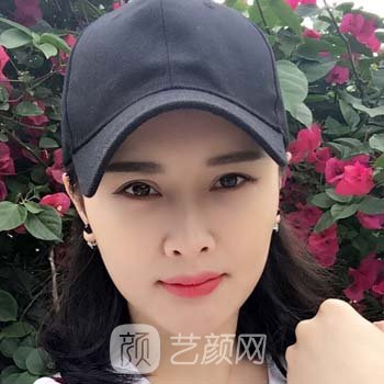 赵广文隆鼻失败修复实例，术后对于鼻子的整体形态感到满意