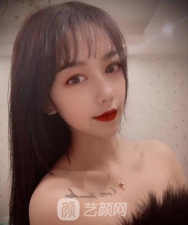 上海周光杰隆鼻实例，仿佛像是换了个人，更美了