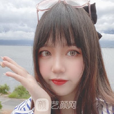 厦门市中医院整形科割双眼皮实例展示｜附90天体验成果图