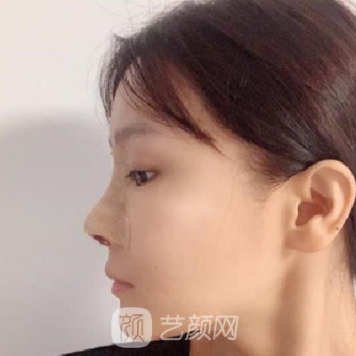 长沙美莱邹俊锋隆鼻实例出炉｜成果自然美观
