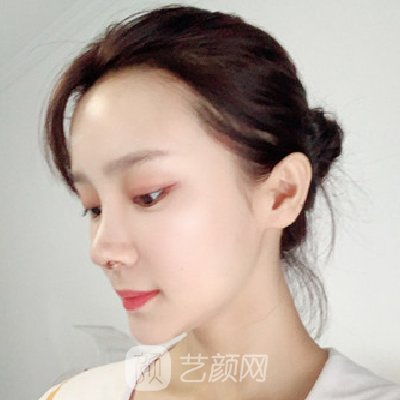 长沙美莱邹俊锋隆鼻实例出炉｜成果自然美观