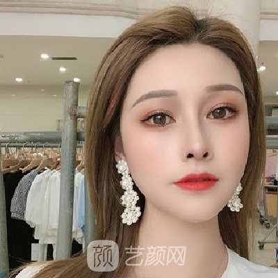 长沙美莱邹俊锋隆鼻实例出炉｜成果自然美观