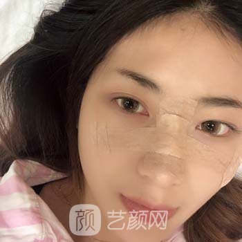 李晨耕隆鼻实例，术后真人分享隆鼻修复过程图片