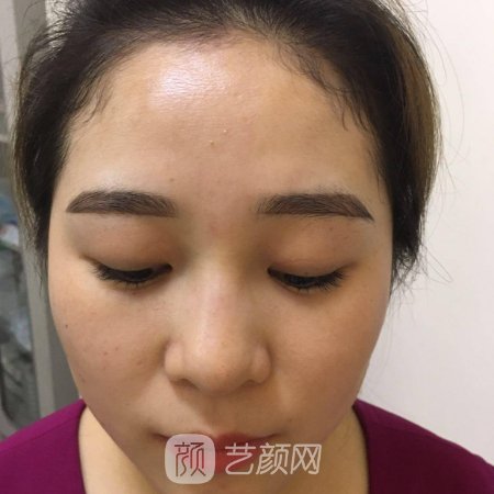 广州南方医院整形科眼综合整形实例公开|附体验成果图