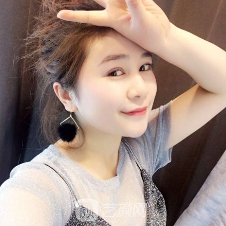 广州南方医院整形科眼综合整形实例公开|附体验成果图